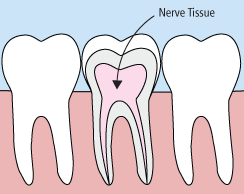 Root Canal Example